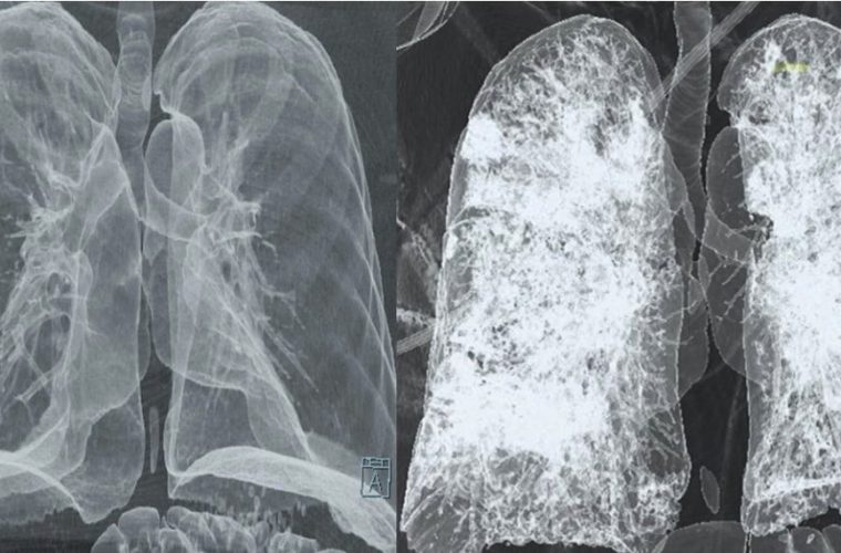 تصویری ترسناک از ریه یک کرونایی